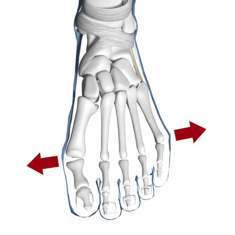 Anatomische Grafik des Spreizfußes. Erkennbar ist eine Fehlstellung des Fußes, bei der sich die Mittelfußknochen immer weiter auseinander bewegen. Somit sinkt das Fußgewölbe ein und unterhalb der Zehen wird der Fuß sehr breit.