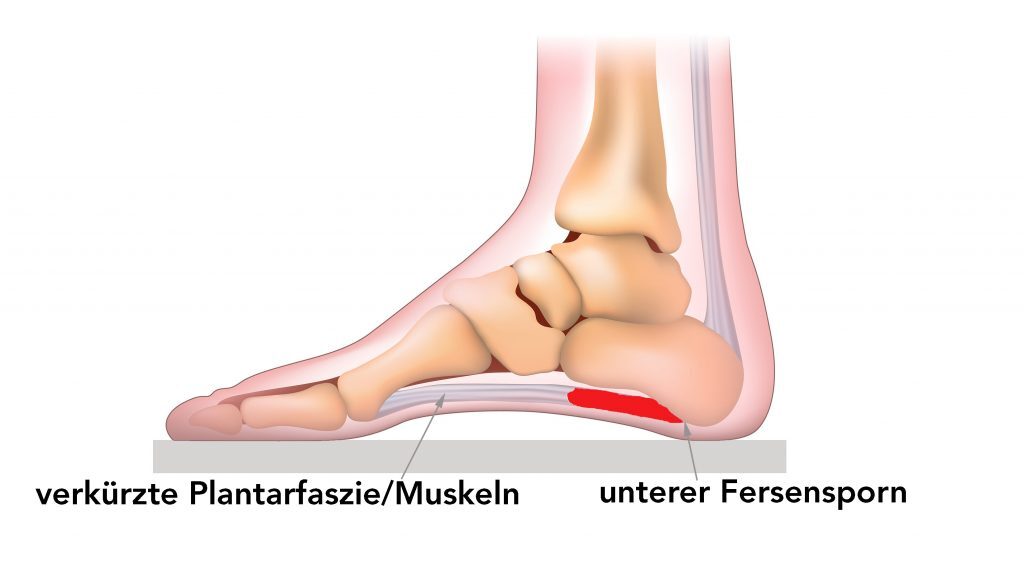 Fersensporn